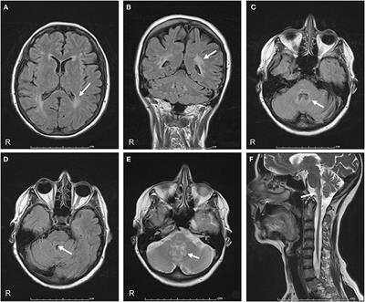 A Novel Mutation of GFAP Causing Adult-Onset Alexander Disease